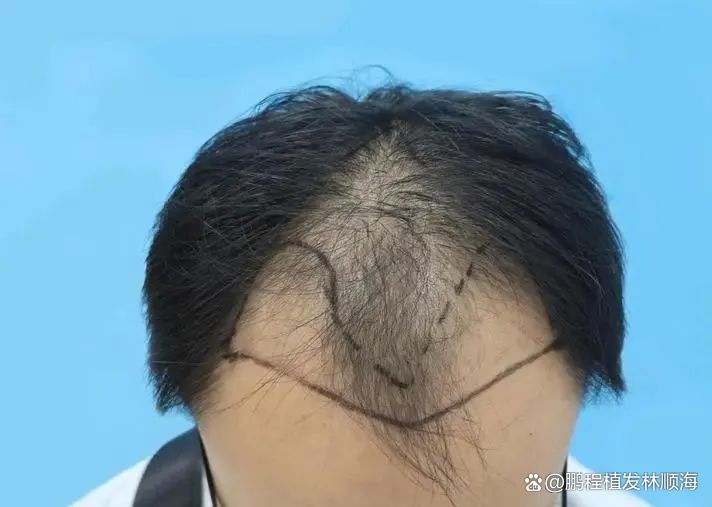 90%以上失败的植发手术，都是因为犯了这些错误！