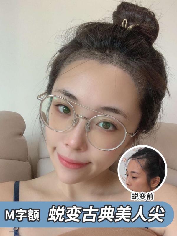 贵阳m型植发，美人尖（案例）