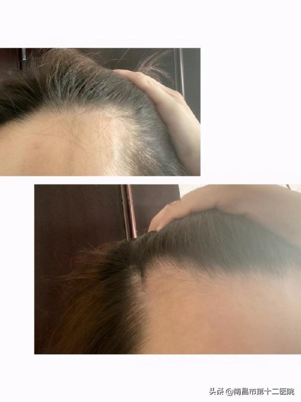 小姐姐分享自己的植发经历，不得不说真的加分不少