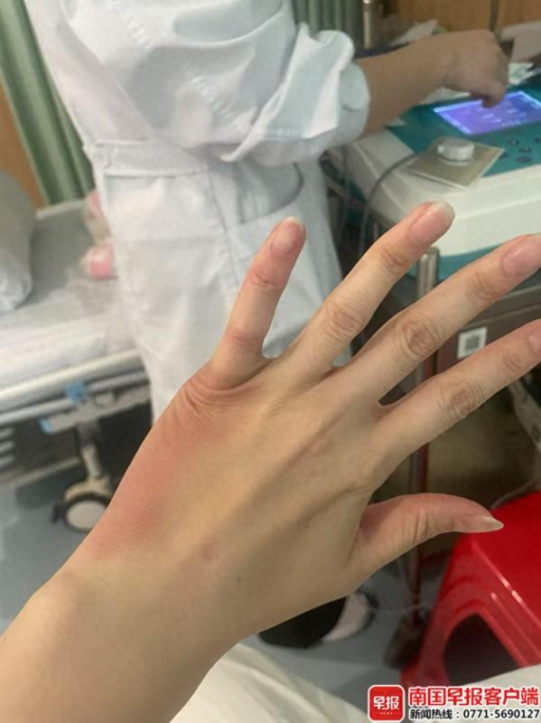 广西一女子做植发手术后，左手疼得睡不着！